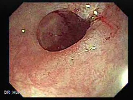 Polyp Inside Of A Diverticulum (10 of 12)