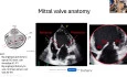 Basics of Mitral Valve Anatomy and Pre-procedural Imaging for Mitral TEER