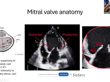Basics of Mitral Valve Anatomy and Pre-procedural Imaging for Mitral TEER