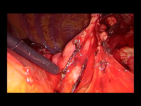 Subxiphoid Uniportal Combined Right Upper Lobectomy and Thymectomy