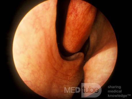 Nasal Septal Spur