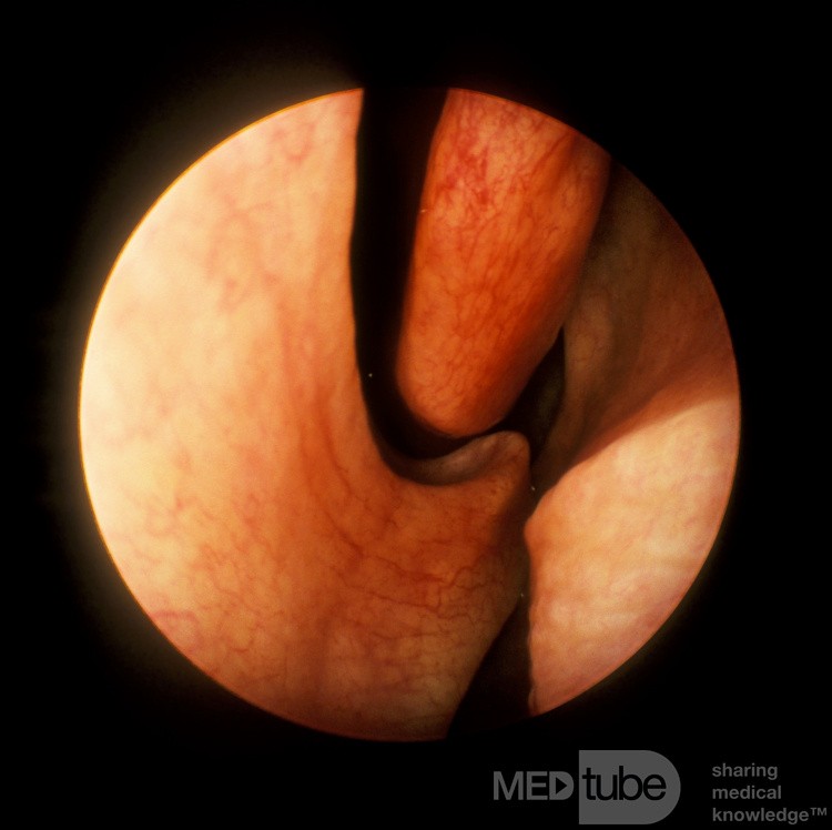 Nasal Septal Spur
