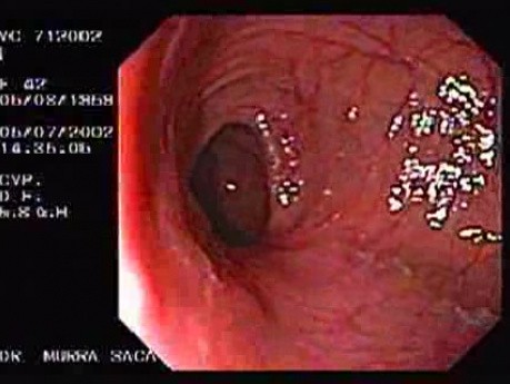 Crohn's Disease - Endoscopy (25 of 28)