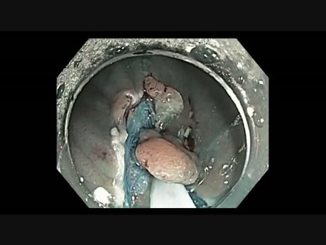 Colonoscopy Channel - EMR of a Linear Flat Cecal Lesion