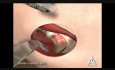 Femoral Acetabular Impingement - 3D Medical Animation