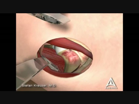 Femoral Acetabular Impingement - 3D Medical Animation