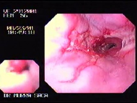 Reflux Esophagitis & Esophageal Stricture - 56-year-old Female