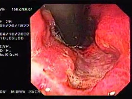 Evolution of a Gastric Carcinoma without a Treatment (4 of 10)