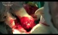 Surgery for giant mediastinal neurinoma