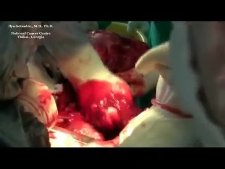 Surgery for giant mediastinal neurinoma