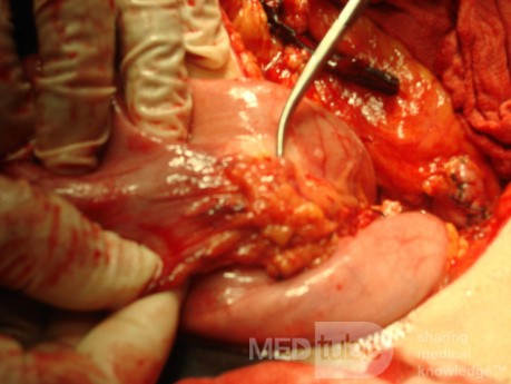 Diffuse Adenocarcinoma with signet ring cells (6 of 18)