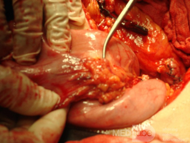 Diffuse Adenocarcinoma with signet ring cells (6 of 18)