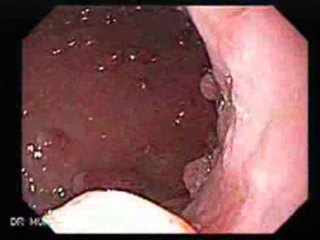 Gastric Polyposis - Endoscopy (4 of 11)