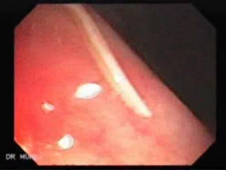 Trichuris Trichiura (3 of 6)