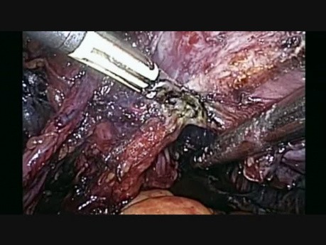 Radical Hysterectomy with Pelvic and Lumbar-aortic Lymphadenectomy in Neuroendocrine Carcinoma of the Cervix.