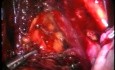 Excision of Lymph Nodes by Use of Laparoscopy