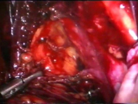 Excision of Lymph Nodes by Use of Laparoscopy