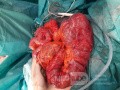Subtotal Colectomy due to Rectosigmoid Obstruction