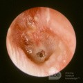 AOMT Acute Otitis Media with Ventilation Tube in Place