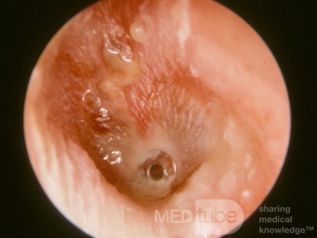 AOMT Acute Otitis Media with Ventilation Tube in Place