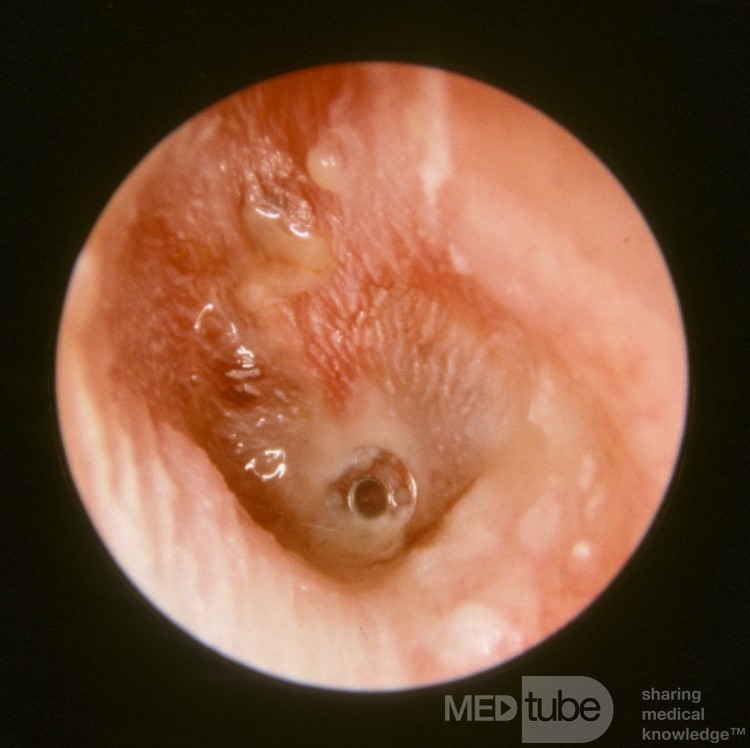 AOMT Acute Otitis Media with Ventilation Tube in Place
