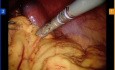 Robotic Distal Pancreatectomy and Splenectomy