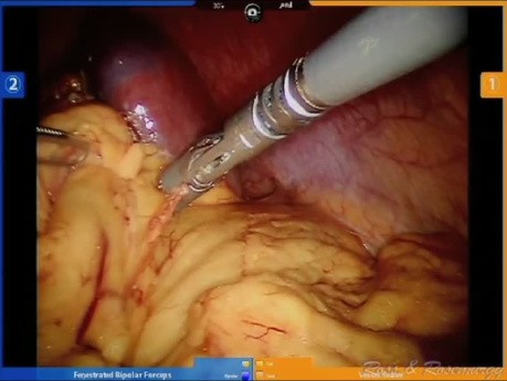 Robotic Distal Pancreatectomy and Splenectomy