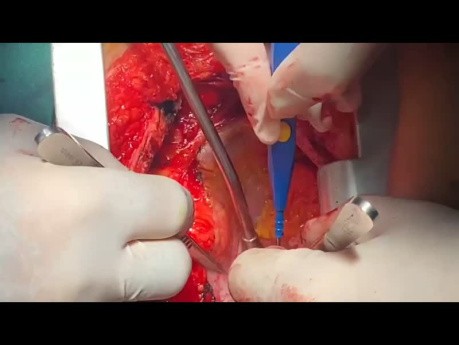 Patient with LA Roof Tumor Undergone Off Pump Resection 