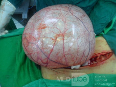 Left ovarian cyst 2