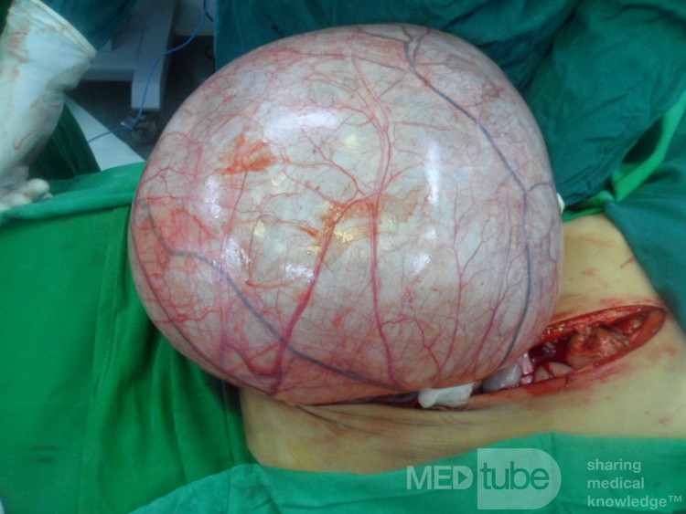Left ovarian cyst 2