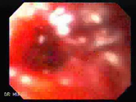Perforation of a Esophageal Carcinoma After the Procedure with Hydrostatic Balloon Dilation- Visible Neoplasia