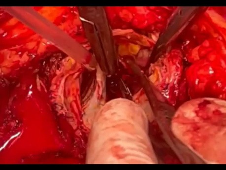 Novel Technique for Trido Arch Dissection Operation 