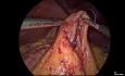 Laparoscopic Revision of Roux-en-y Gastric Bypass to Sleeve Gastrectomy in Patient With Reactive Hypoglycemia