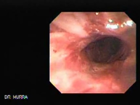 Traqueostomy Fistula (1 of 5)