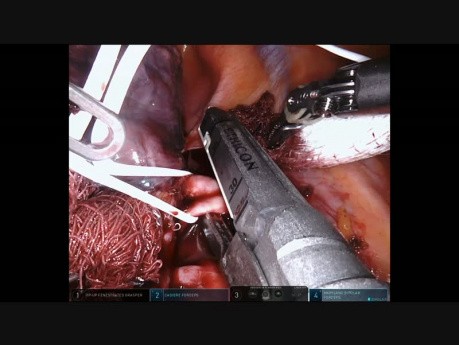 RUL Lung Cancer - Robotic Lobectomy