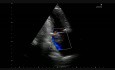 Left atrial tumor (2/2)