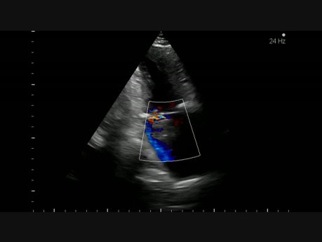 Left atrial tumor (2/2)