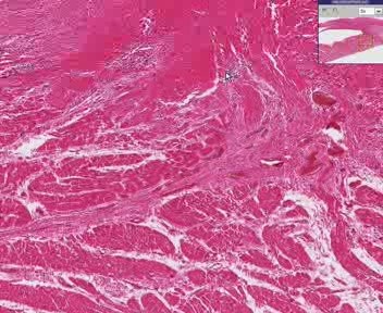 Endocarditis - Subacute Endocarditis

