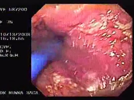Esophageal Achalasia (13 of 16)