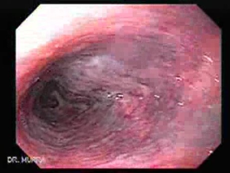Alcoholic Cirrhosis - 62 Years-Old Physician