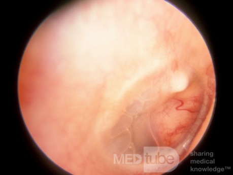 Acquired Meningoencephalocele