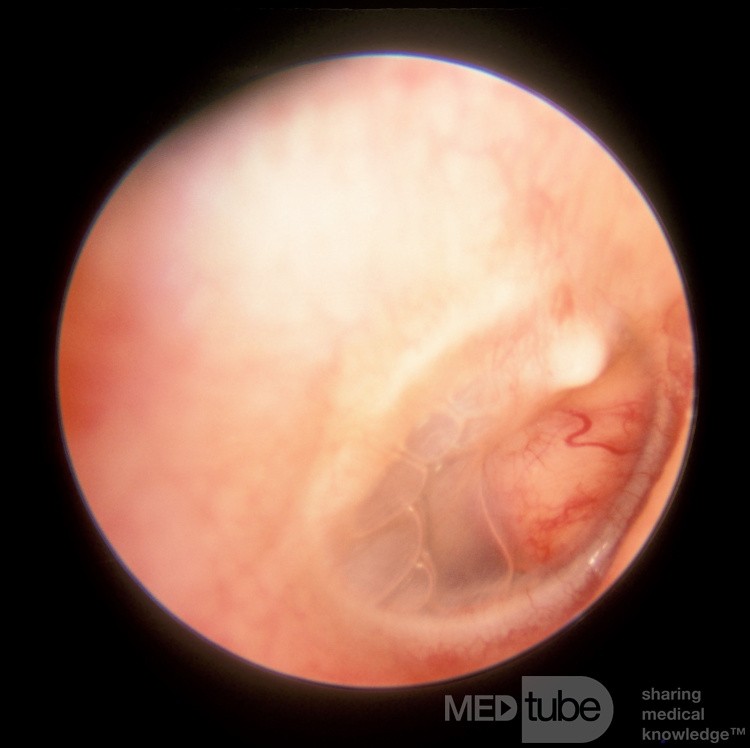 Acquired Meningoencephalocele