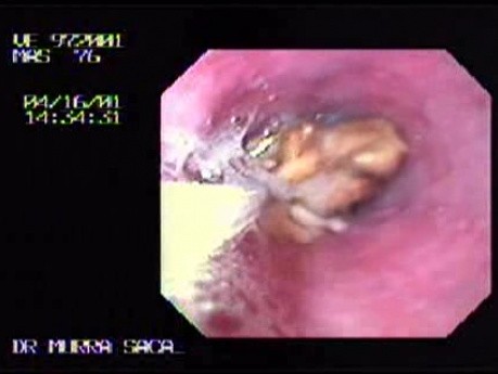 Polypectomy Snare in Non-typical Usage - Foreign Body Retrieval