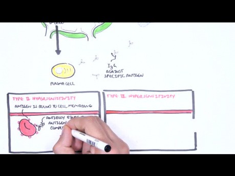 Hypersensitivity Type III (Immune Complex Hypersensitivity) - Causes, Pathophysiology