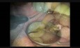 Implant Microsurgery: Replacing Broken Implant Screw
