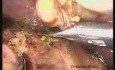 Two-Port Laparoscopic Cholecystectomy