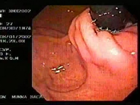 Post Fundoplication Endoscopic Examination (2 of 5)