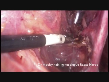 Radical Hysterectomy and Ovarian Transposition in Early Cervical Cancer 