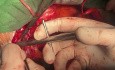 Patient with Uremic Percarditis and Three Vessels Disease and Calcified Ascending Aorta