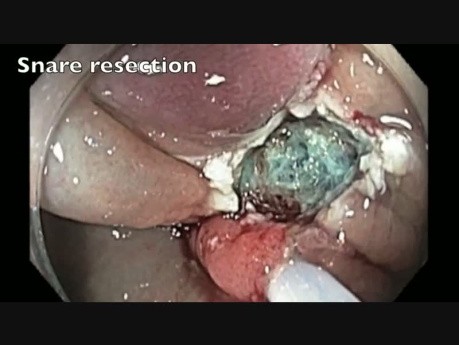Colonoscopy - Ascending Colon - Flat Lesion - Step II - Snare Resection